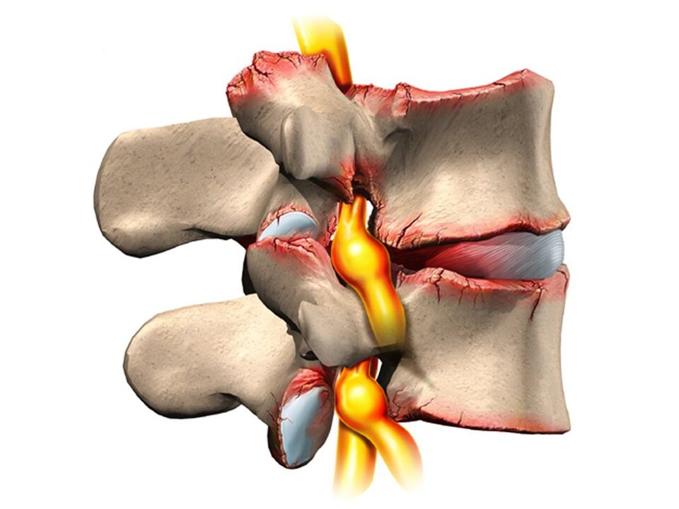 Поражение позвоночника при остеохондрозе