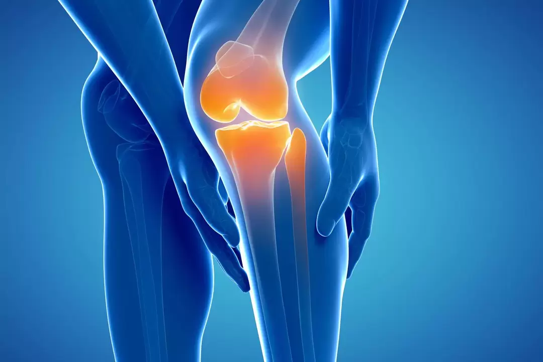 Артроз коленного сустава (гонартроз, деформирующий артроз)